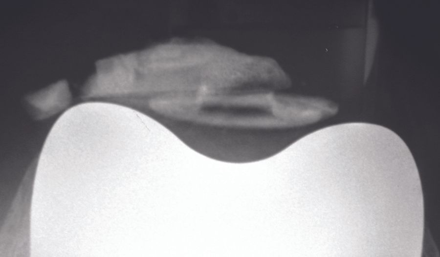 Arthrolyse arthroscopique pour raideur  sur prothèse totale du genou