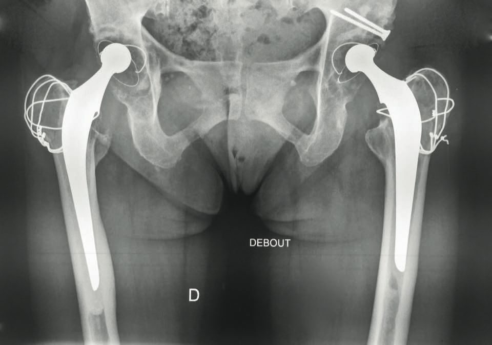 Est-il possible et utile de réduire la longueur originale d’une tige Charnley-Kerboull cimentée ?
