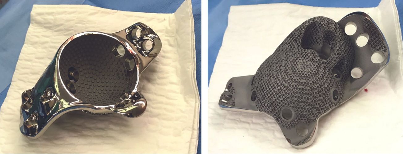 Une nouvelle approche pour la reconstruction de défauts acétabulaires Paprosky 3 à l’aide d’implants spécifiques aux patients  imprimés en 3D sur la base d’une évaluation  de la qualité osseuse