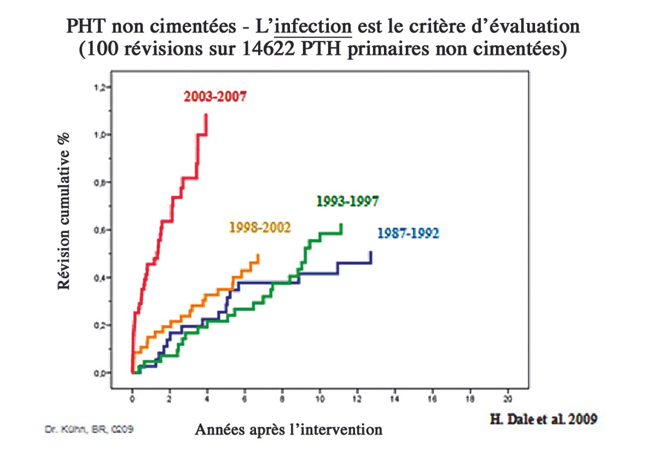 Le ciment osseux : rôle confirmé des antibiotiques