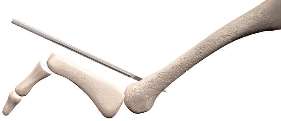 (Extrait) Chirurgie mini-invasive et percutanée du pied - 2ème édition - chapitre DMMO