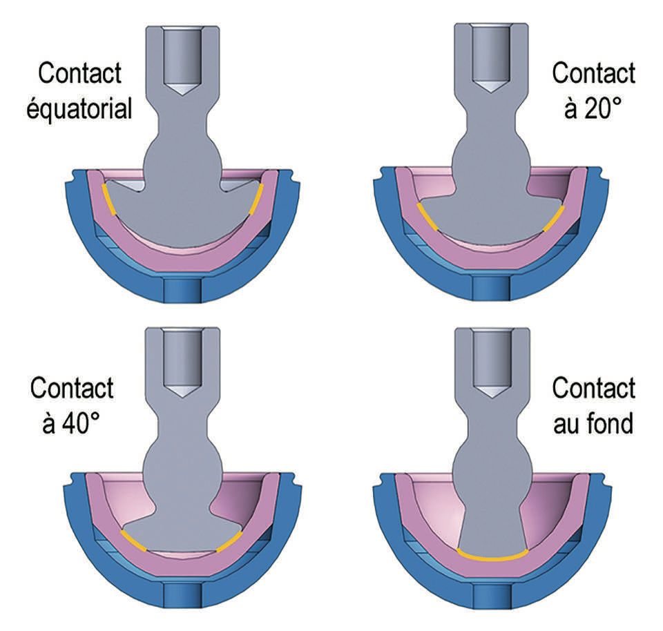 Positionneur/impacteur de céramique dans les prothèses totales de hanche : Contraintes et étude de faisabilité avec le système ORTHOGUN®