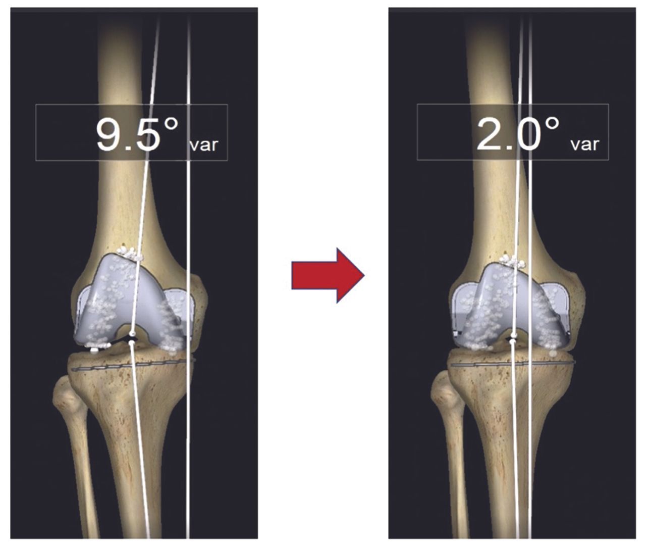 La chirurgie assistée par ordinateur au service de l’alignement et de l’équilibrage personnalisé dans les prothèses totales du genou
