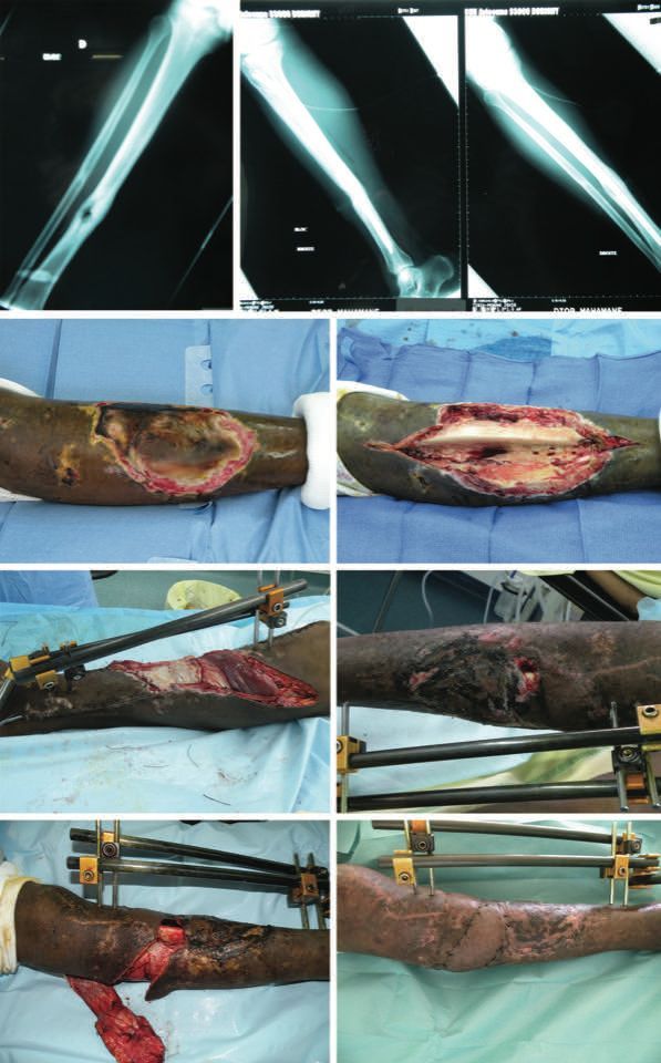 Traitement chirugical de l'infection osseuse