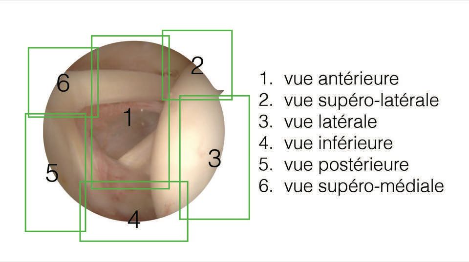 Exploration Arthroscopique  de l’Articulation Gléno-Humérale