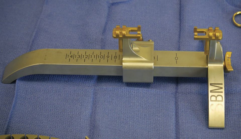 Greffe courte du LCA : Technique Dehors-dedans avec tunnels complets