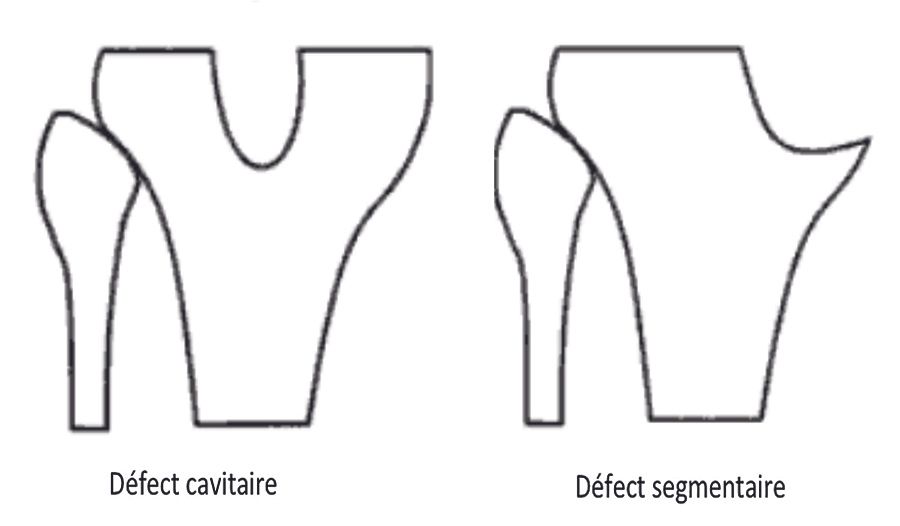 Reprise de Prothèse Totale du Genou : une nouvelle approche pour la gestion  des pertes de substance osseuse