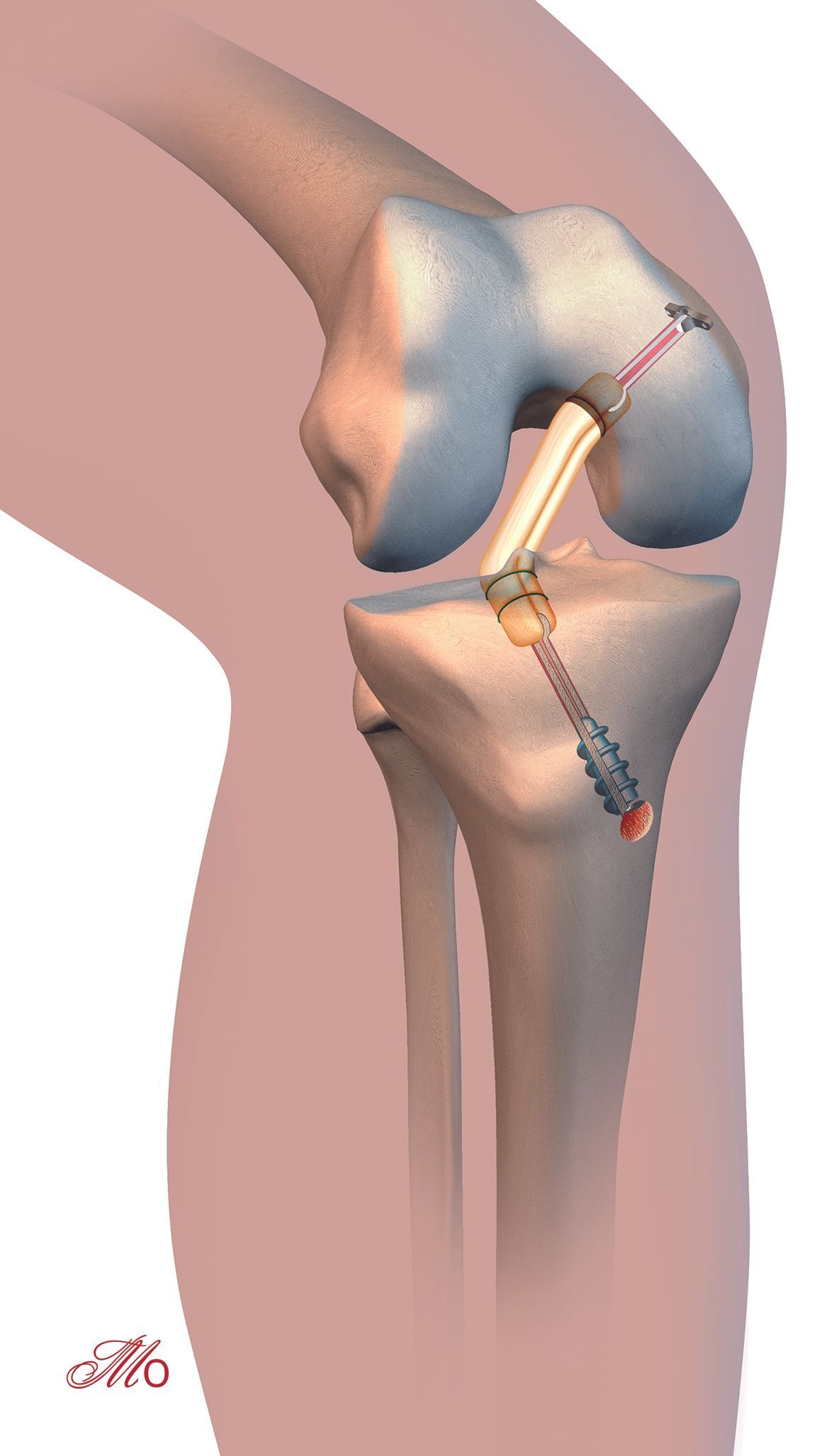 Reconstruction du ligament croisé postérieur du genou sous arthroscopie