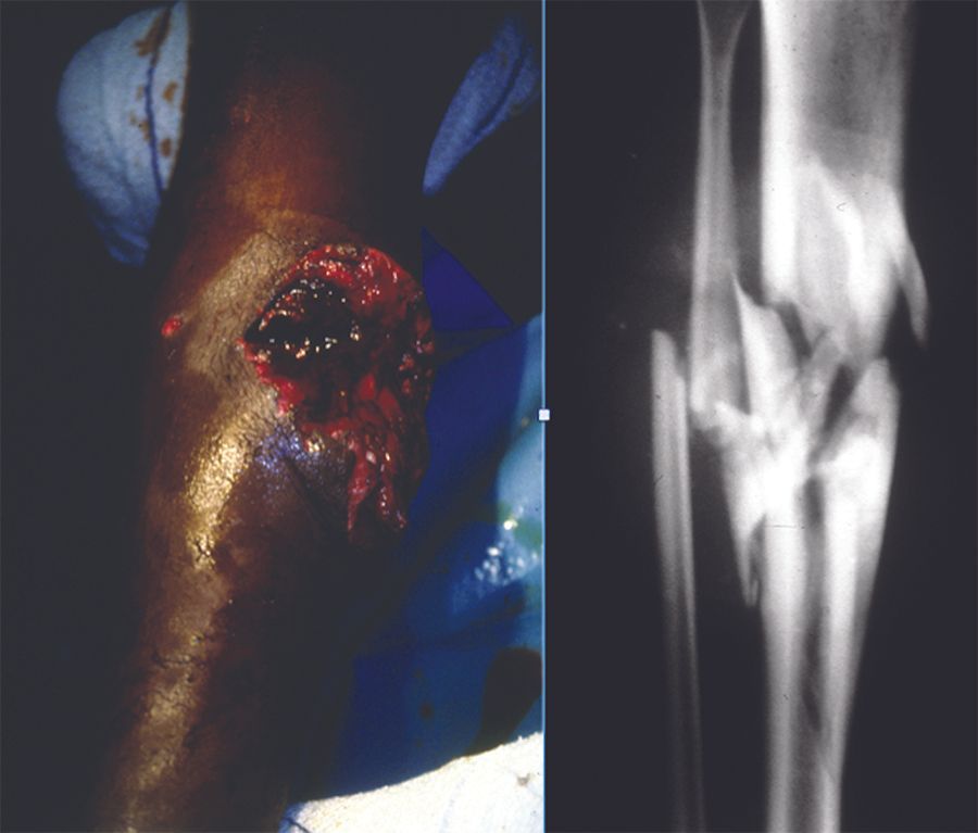 Prise en charge lors d'attentat de blessés des membres par armes de guerre et par explosion