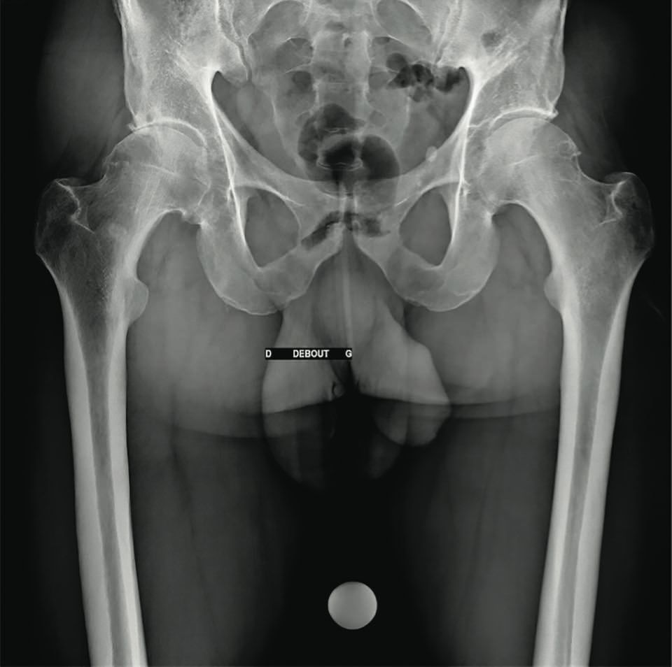 Analyse de la fiabilité du logiciel Traumacad  et de l’influence du chirurgien  dans la programmation  des prothèses totales de hanche