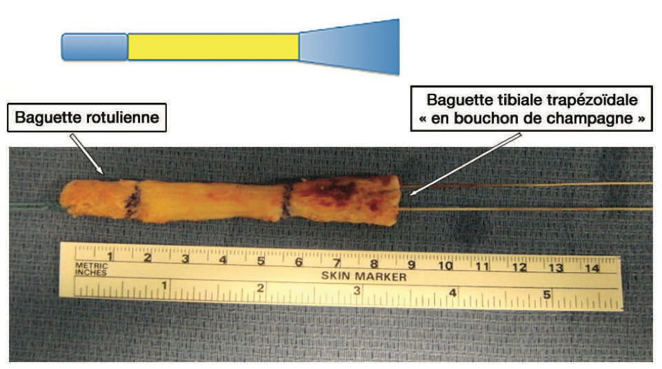 Technique chirurgicale de ligamentoplastie du LCA en « OUT-IN » Particularité de la technique « lyonnaise »