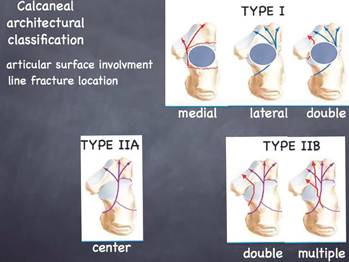 Ostéosynthèse des fractures thalamiques du calcanéus  par clou verrouillé (Calcanail)