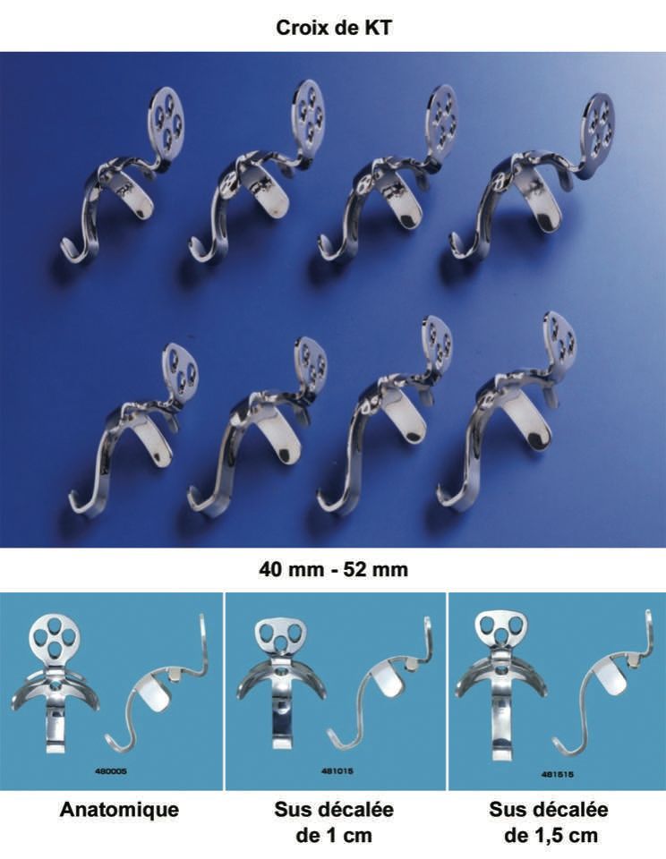 Reconstruction acétabulaire  à l’aide de l'armature Kerboull-Tanaka