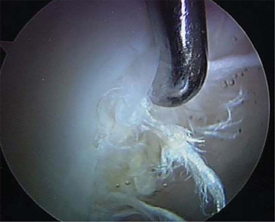 Reconstructions arthroscopiques capsulo-ligamentaires de hanche