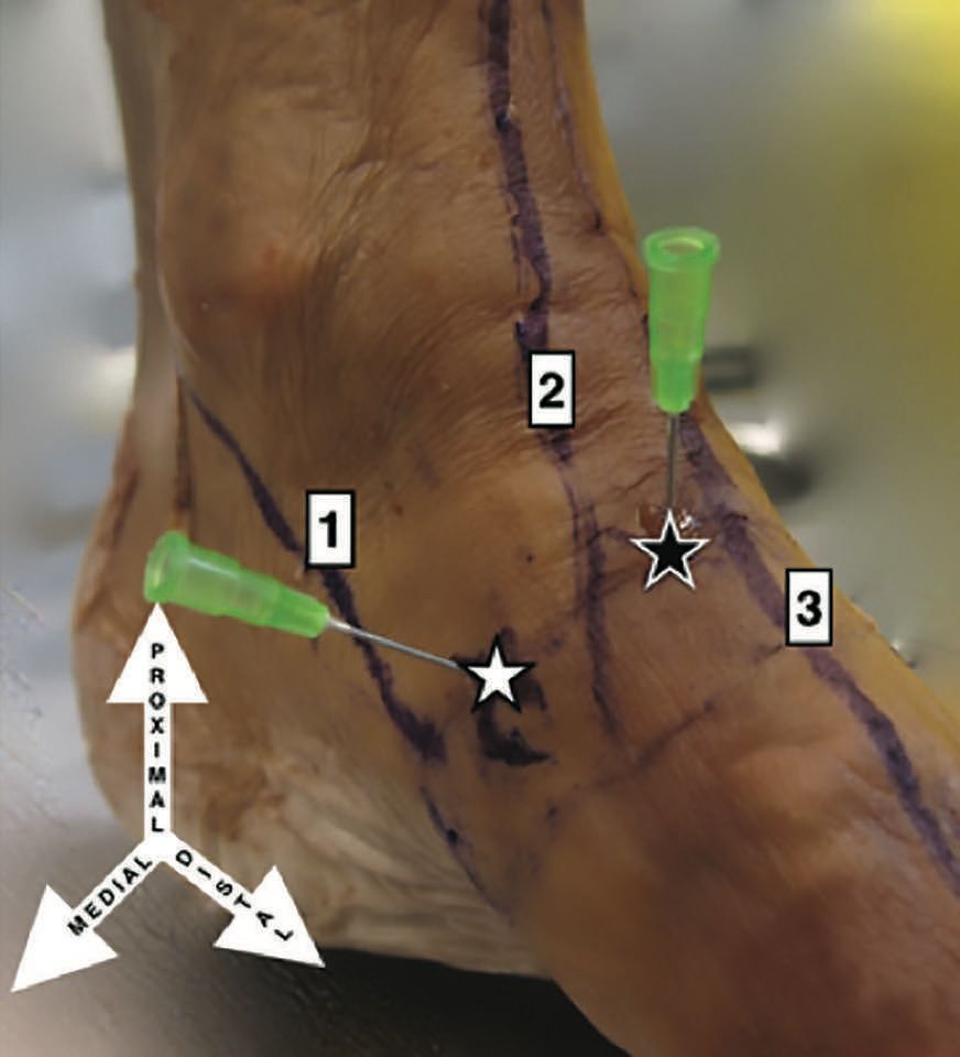 Arthrodèse arthroscopique médiotarsienne utilisant un distracteur