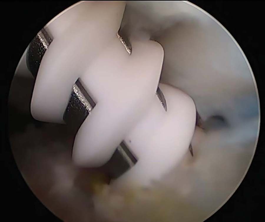 La réparation en double rang de la coiffe des rotateurs par sutures croisées par Ultratape