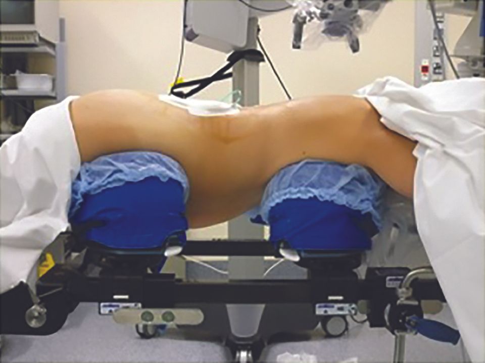 Arthrodèses cervicales et lombaires utilisant  une cage intersomatique avec greffon osseux allogénique enrichi en concentré de moelle osseuse