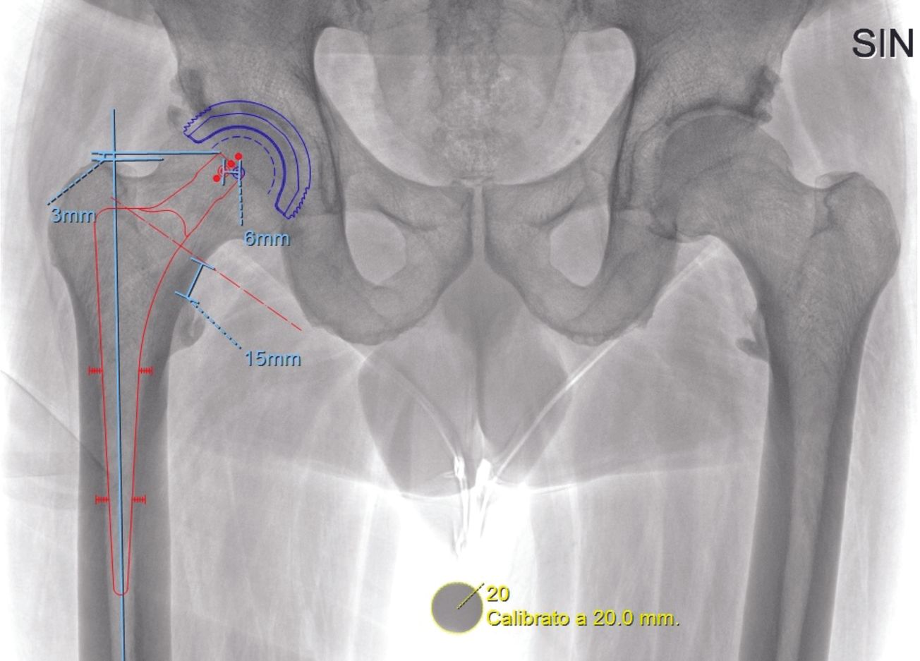 Syndrome hanche-rachis et luxation de la PTH : implications chirurgicales