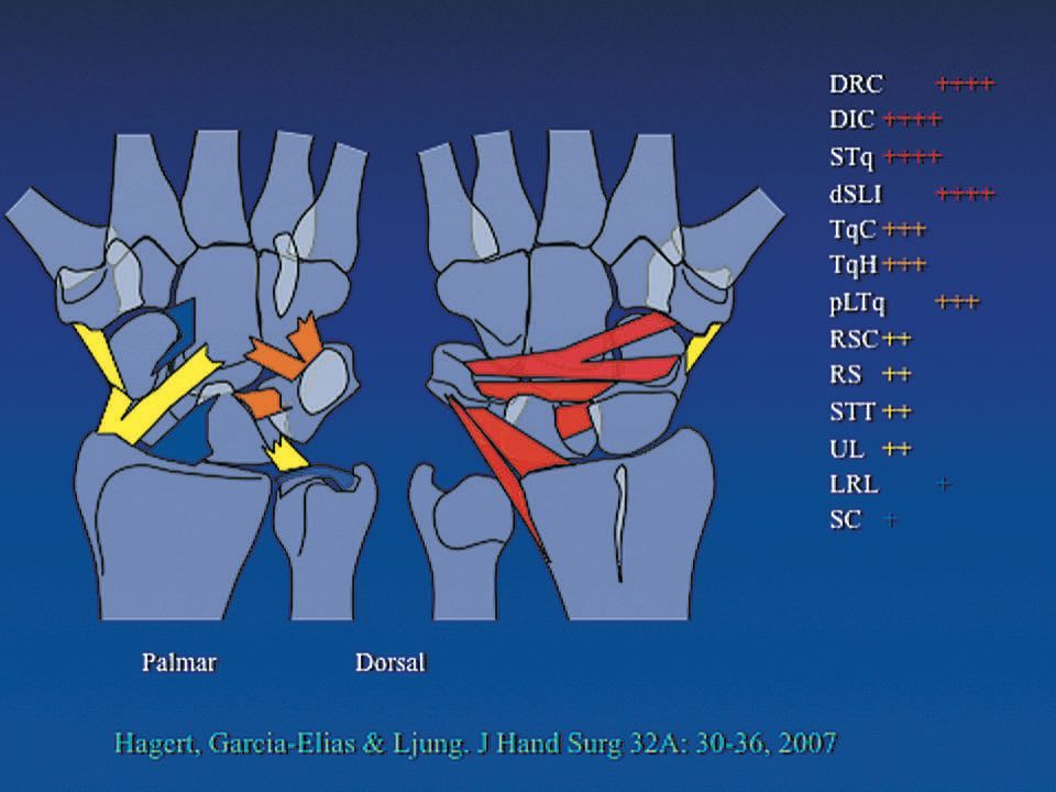 Algorithme pour le traitement de l'instabilité scapho-lunaire