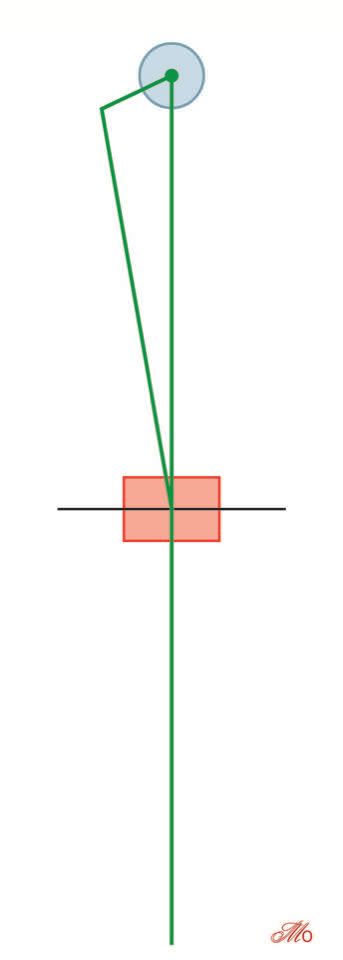 Prothèse totale de genou et déformation osseuse extra-articulaire