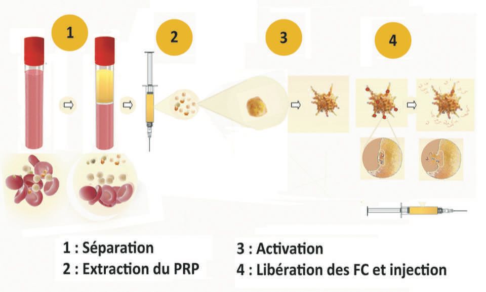 Les concentrés plaquettaires et leurs applications
