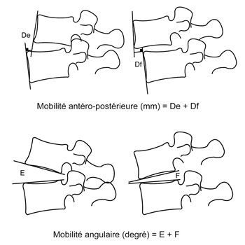 Instabilité et sténose lombaire... quand réaliser une arthrodèse ?