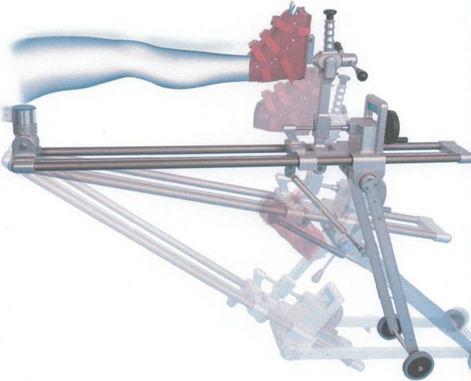 Prothèse intermédiaire de la hanche par voie d’abord antérieure avec le positionneur de jambe medacta pour table orthopédique dans les fractures du col du fémur