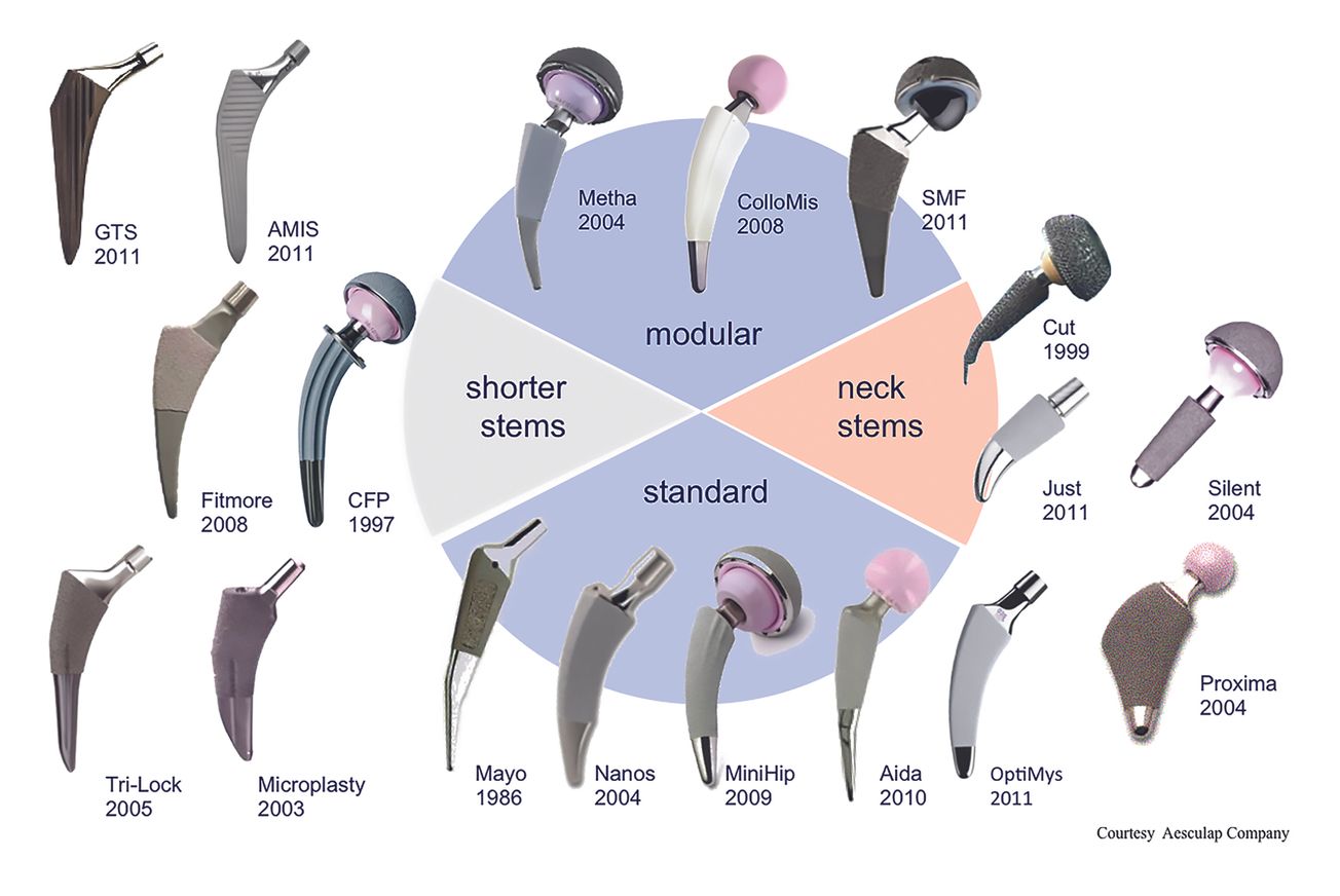 Prothèses à tiges courtes dans l’arthroplastie prothétique de hanche : Exposé sommaire des classifications et des indications