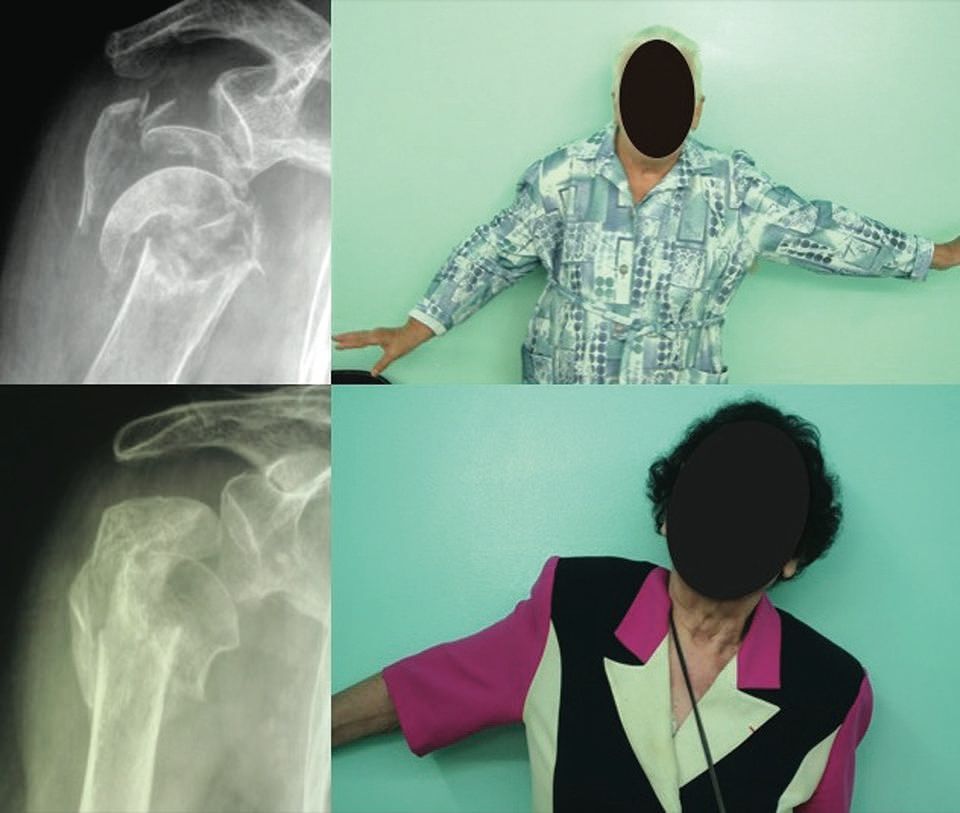 Quel traitement pour les fractures "4 fragments" du sujet de plus de 70 ans ? La place de la prothèse inversée et ses perspectives d’avenir au vu de ses résultats dans l’omarthrose