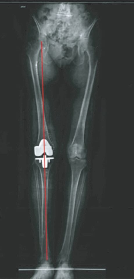 Intérêt des guides de coupe sur mesure  après une planification preoperatoire scanner 3d dans la mise en place  d’une prothèse totale de genou