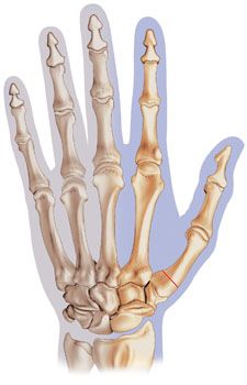 Le rizarthrose - Traitement chirurgical au fil du temps