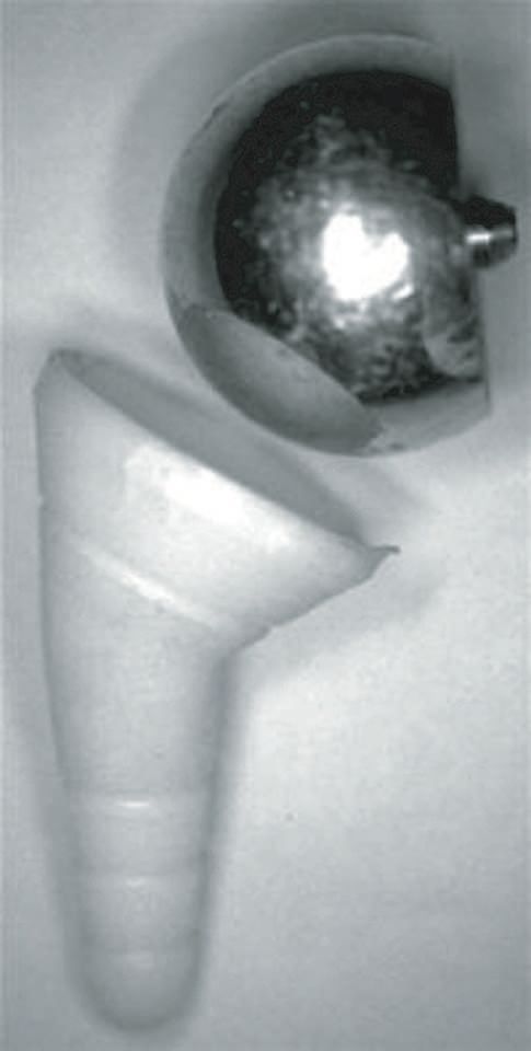 La prothèse inversée d’épaule duocentric®  et ses gabarits de pose personal fit®  Propositions innovantes pour optimiser le positionnement prothétique et prévenir le problème de l’encoche scapulaire