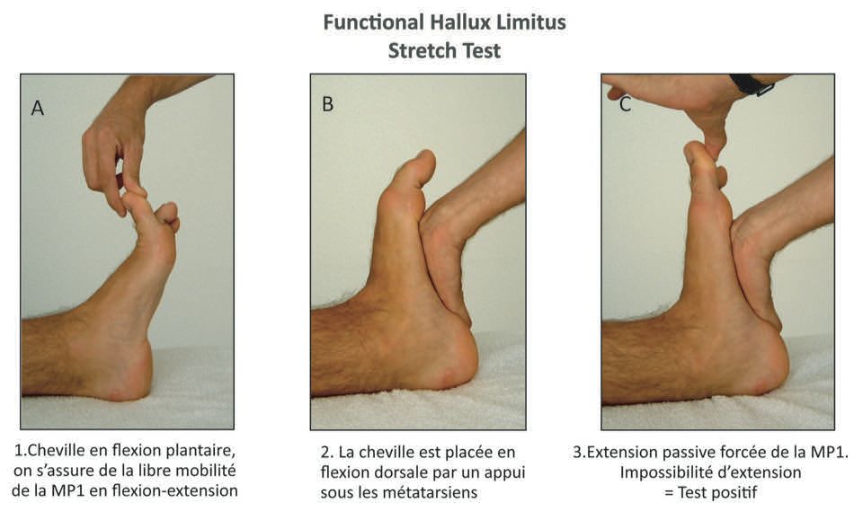 L'hallux limitus fonctionnel ou "L'oeuf de colomb" de l'orthopédie