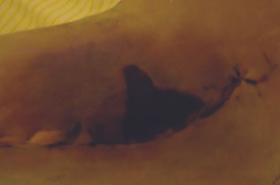 L’enclouage verrouillé de la fibula par XS Nail* pour la préservation des parties molles : un nouveau concept dans la prise en charge des  fractures bimalléolaires et du pilon tibial