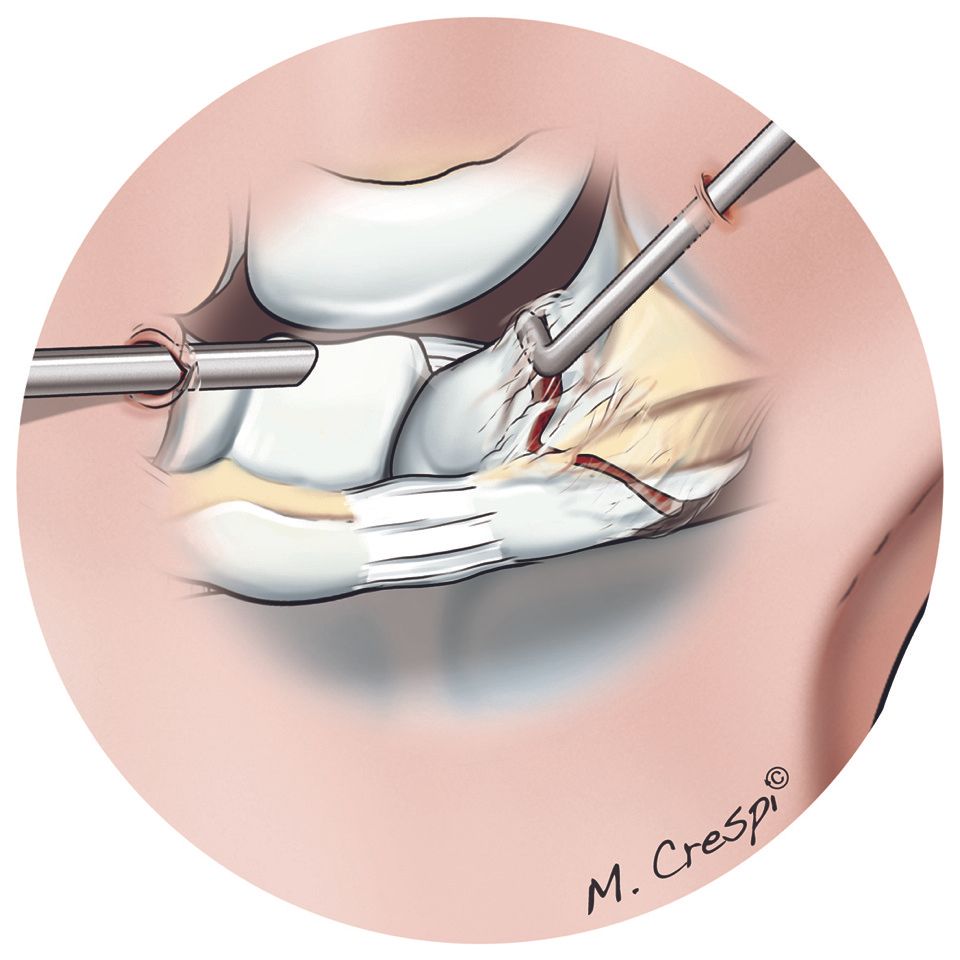 Intérêt de l’arthroscopie dans le traitement  de la pseudarthrose du scaphoïde carpien