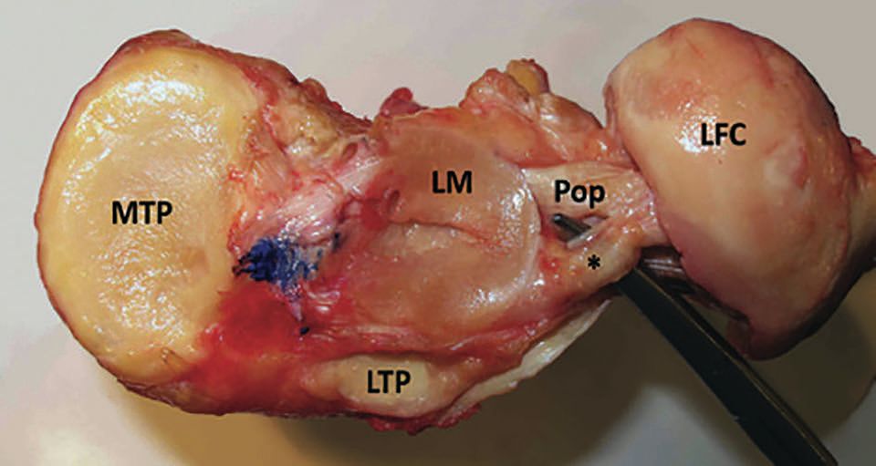 Le ligament antérolatéral du genou
