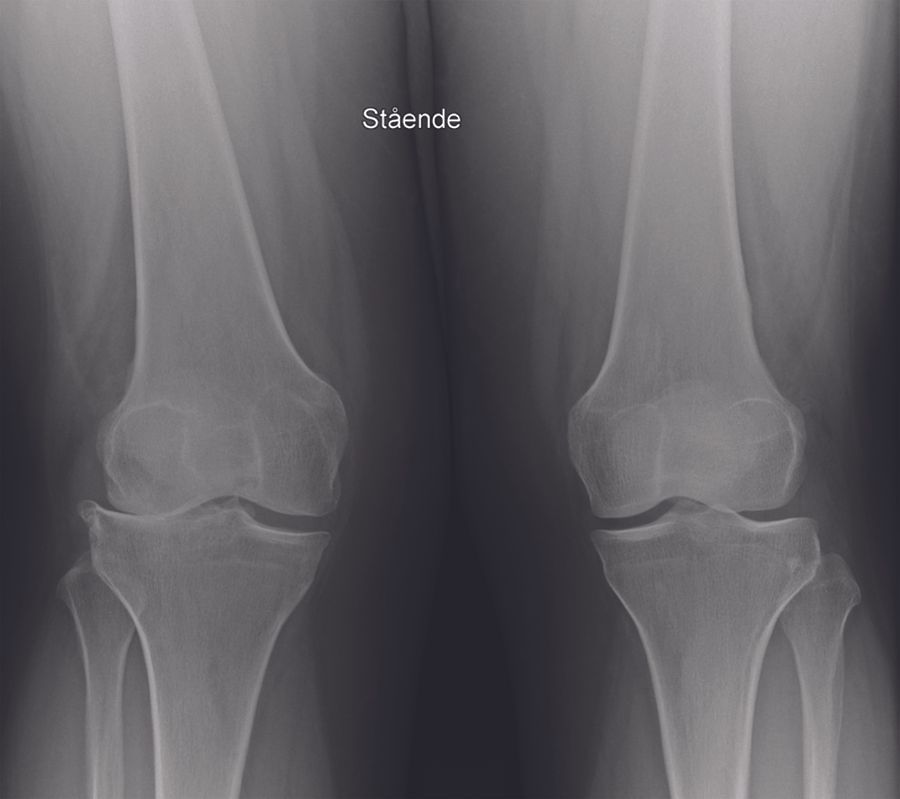 Comment je réalise une prothèse unicompartimentale  latérale du genou à plateau fixe