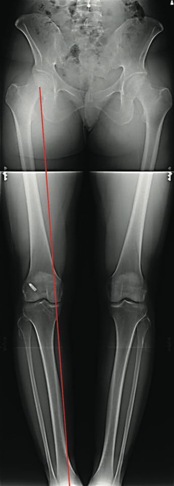 Gestion des tunnels osseux pour les reconstructions itératives du LCA  Quelle stratégie ?