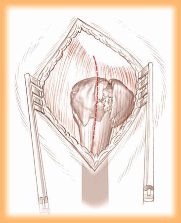 Fractures complexes de l'humérus proximal : Apport de la tige Bilboquet