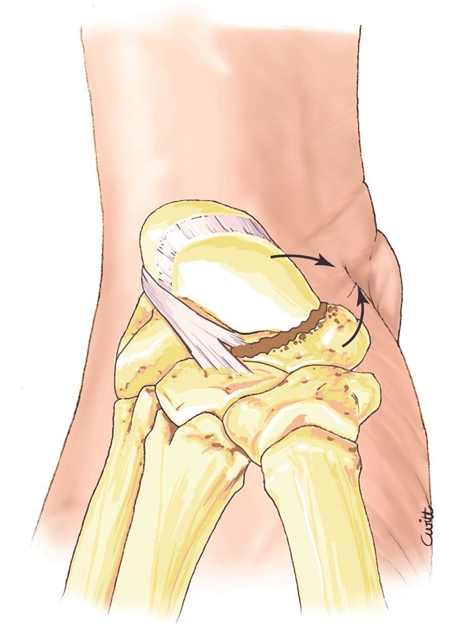 Chirurgie de la main :  Affections rhumatismales, dégénératives. Syndromes canalaires