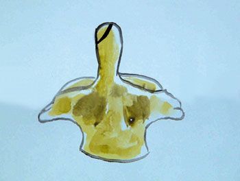 Traitement chirurgical des fractures de l'odontoïde par vissage antérieur