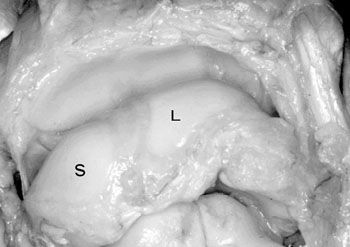 Arthroscanner du poignet