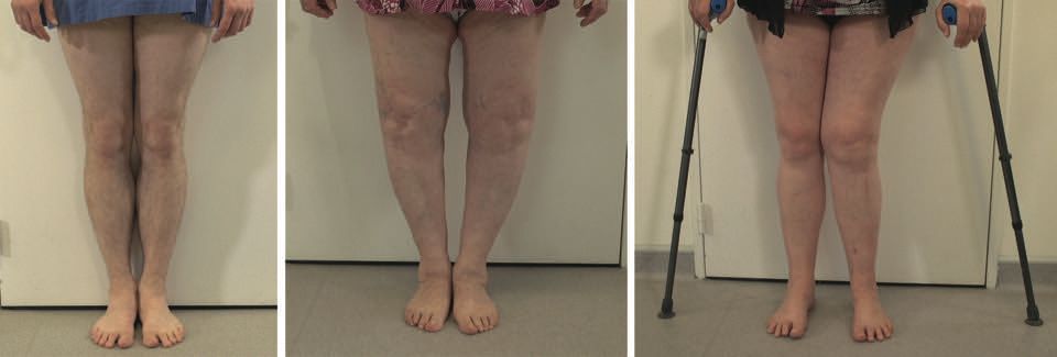 Examen clinique du genou (Pathologies ligamentaires et méniscales)