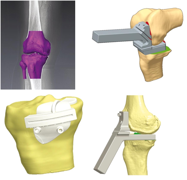 Les guides de coupe pour la mise en place d'une prothèse unicompartimentale : Une avancée pour les PUCI et PUCE ?