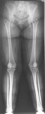 Ostéotomie fémorale distale de varisation par soustraction interne.