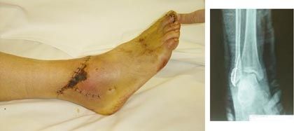 Chirurgie réparatrice en situation précaire - Couverture de la cheville