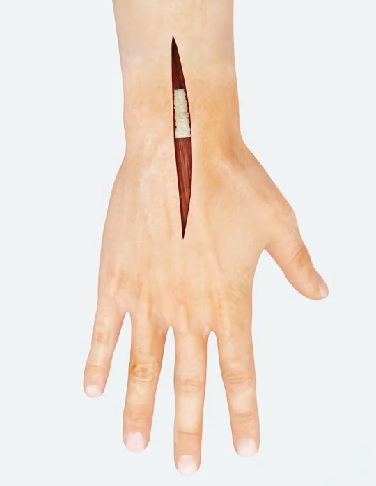 Prothèse isoelastic radius distal