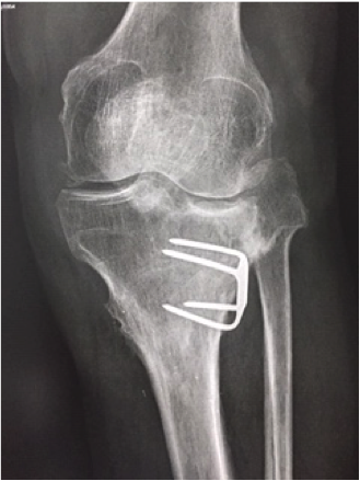 Conception moderne des ostéotomies autour du genou dans l’arthrose fémoro-tibiale monocompartimentaire