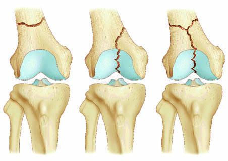 Les fractures supra-condyliennes du fémur : enclouage centro-médullaire