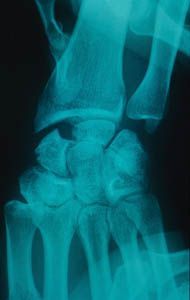 Y a-t-il des indications à l'excision partielle du scaphoïde ?